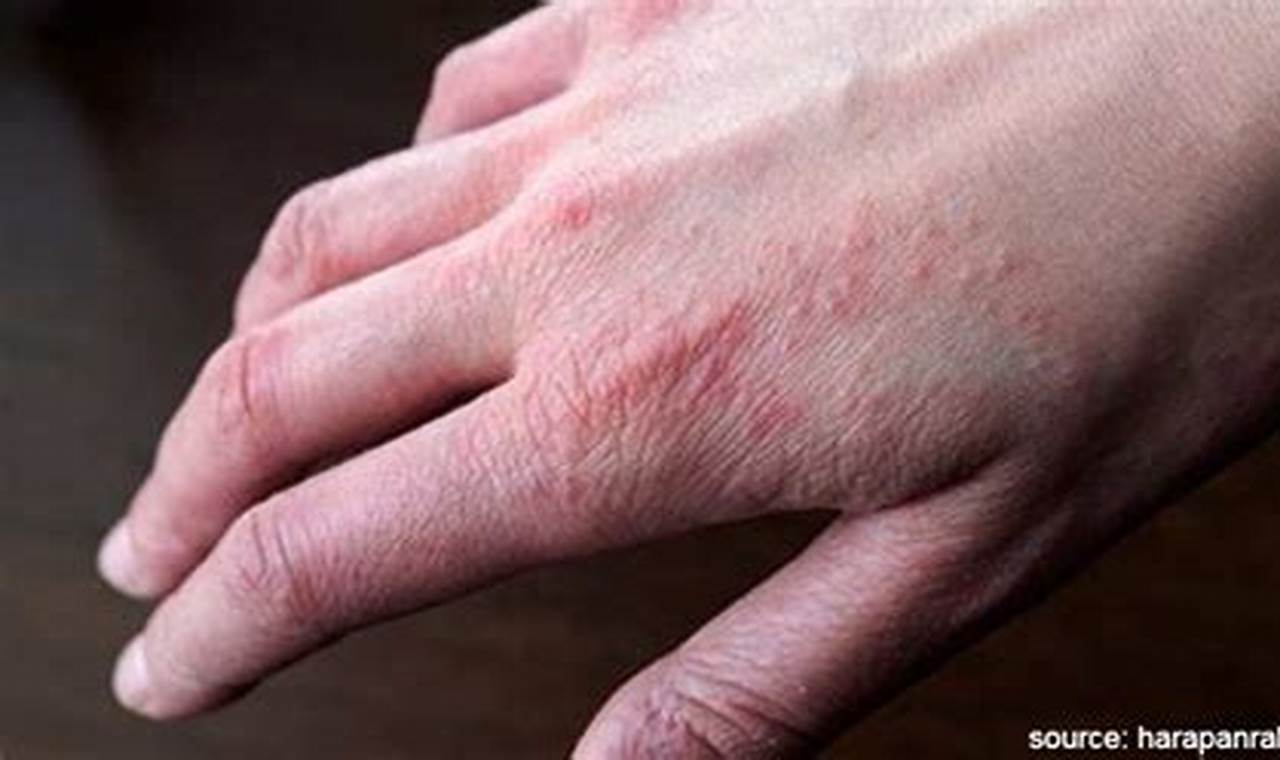 Cara Mengatasi Alergi Kulit Dengan Mudah